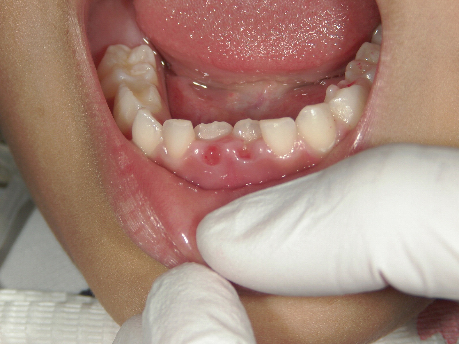 歯並び の ため に 乳歯 を 抜く